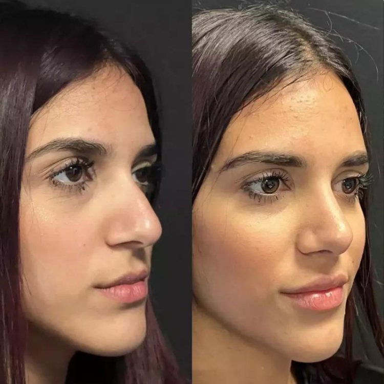 Rhinoplasty in Dubai: Discovering the Latest Trends and Techniques
